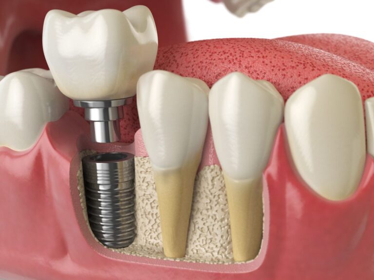 dis-tedavisinde-yeni-donem-implant-ssk-kapsamina-giriyor-wp2x63ex.jpg